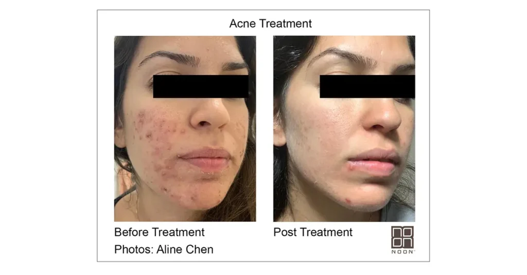 NOON Acne Treatment